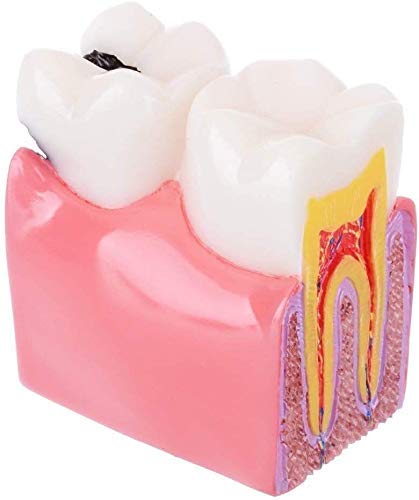 Insegnamento del Modello di Anatomia Dentale Educazione per Studenti di Odontoiatria E Ricerca sulle Carie 6 Volte Studio Comparativo del Modello 1 Strumento Assistente di Biologia Anatomica
