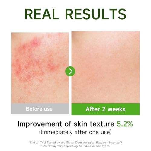 Gaayou Centella Asiatica Serum Centella Tea Tree Ampoule Facial Serum Korean Centella Serum for Acne-Prone Oil Skin Soothing, Calming, Reduce Redness 105ml