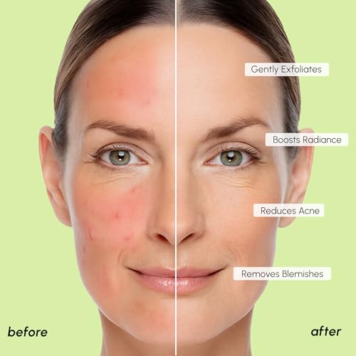 Image of MAREE Blemish Acne Clearing Polishes - Daily Facial Radiance Toner Pads - Witch Hazel Pads Acne Face Toning - Acne Skin Care with BHA Salicylic Acid - Blemish Clearing Witch Hazel Device