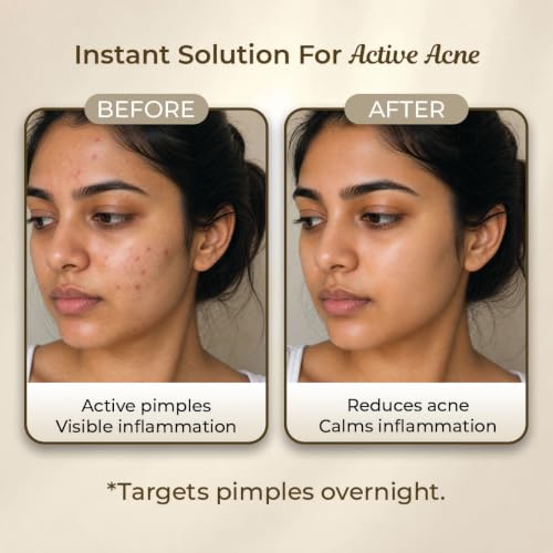 Image of Sanfe Hydrocolloid Face Acne Clearing Pimple Patches