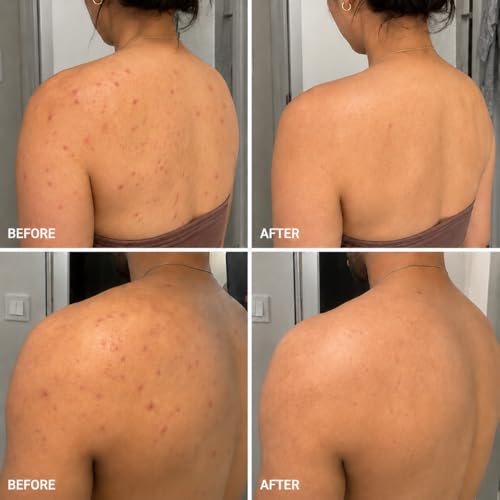 Image of BellamiLuxx Body Acne Soap Bar: Tea Tree Body Acne Soap for Butt Acne, Bacne & Folliculitis Bumps - Salicylic Acid & Sulfur Extract Clarifying Bar - Helps Reduce Bumps, Clogged Pores & Rough Texture