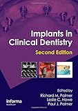 Implants in Clinical Dentistry