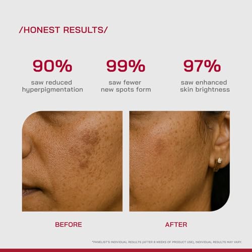Image of /PHD / 2% Alpha Arbutin Depigmentation | Alpha Arbutin Serum for Pigmentation & Dark Spots | Face Serum for Women & Men | Formulated with Global Dermatologists | 30ml