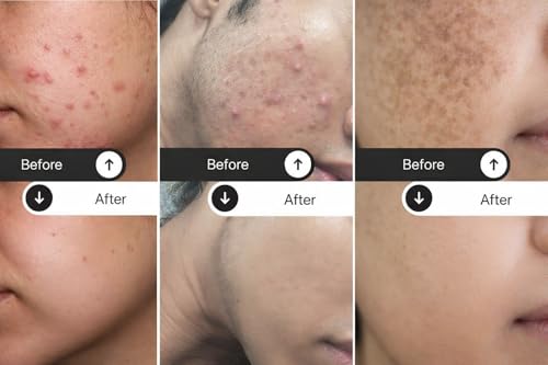 Image of 3% Niacinamide & Rice Water Face Toner | Acne Prone Dry Combination Skin | Fades Blemishes, Brightens & Smoothens | Women & Men | 100ml | Alcohol-Free