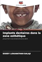 Implants dentaires dans la zone esthétique 6205653818 Book Cover