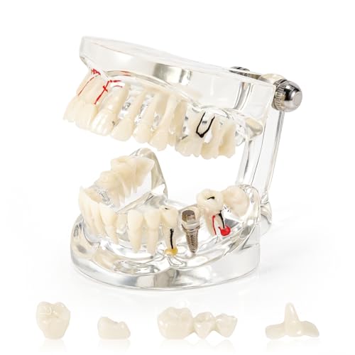 Annhua Transparent Disease Teeth Model for Dental Students, 32 Standard