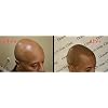 B - Scalp micropigmentation pigments by DermMicro (B)