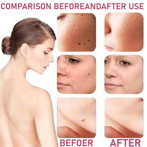 Image of Wart Cream Fast Acting Gel Fast-Acting， Wart Remover Wart Remover Cream for Face, Body and Hands