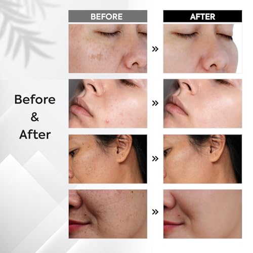 Pigmentflecken Entferner Gesicht Anti Pigment: Dark Spot Correcting Glow Serum mit Niacinamid & Vitamin C – Hyperpigmentierung Reduzierung gegen Melasma, Altersflecken & Sommersprossen