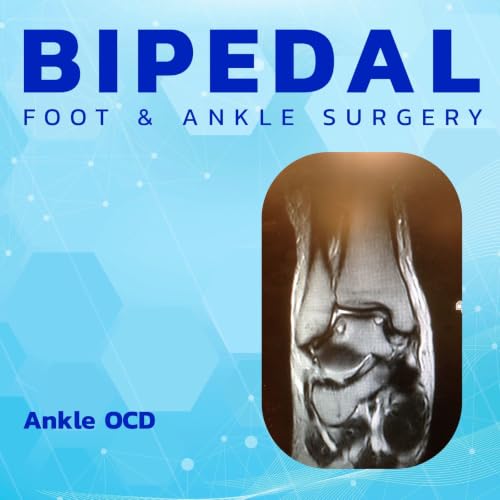 Ankle OCD