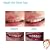 MeiKai Temporary Tooth Temp Tooth Repair Kit Fix Teeth Temp Tooth Veneer Teeth Filling Kit Denture Adhesive Fake Teeth Cosmetic Braces Veneer-Best Moldable Thermal Fitting Beads
