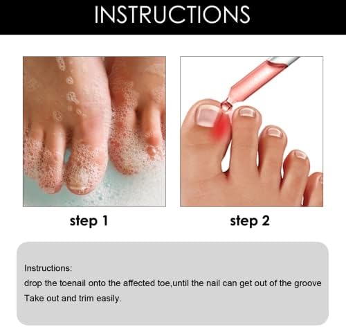 Ingrown Toenail Treatment - Ingrown Toenail - Cuticle Care Oils for Ingrown Toenails - Trimming Toenail Softening Drops Natural Ingrown Toenail Correction Treatment Fungal Nail Treatment - 10ml (1Pcs)