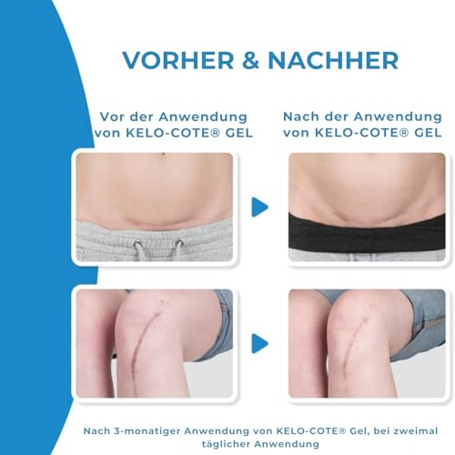 KELO-COTE Silikon-Narben-Gel 6g für chirurgische Narben, erhabene, wulstige Narben wie hypertrophe Narben und Keloide, Verbrennungen, Verletzungen, Kaiserschnitt