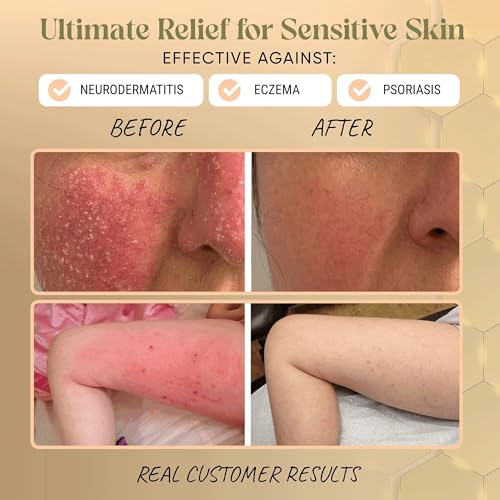 Manuka-Honig-Hanf-Salbe für Neurodermitis & Ekzeme, Schuppen - Propolis, Bienenwachs, Aloe Vera- Dermatologisch Empfohlen, Heilt Trockene, Rissige Haut