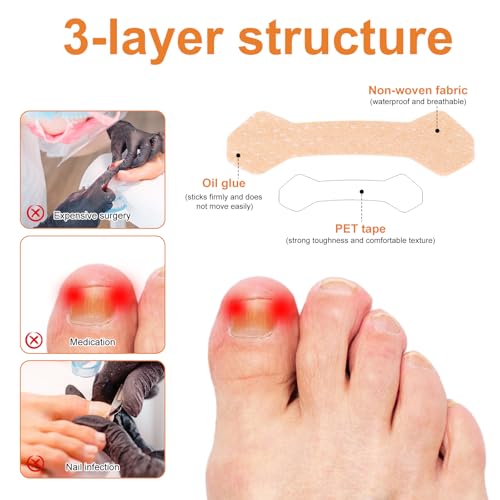 150 peças de tiras encravadas para unhas dos pés, corretor de unhas encravadas respiráveis, ferramen