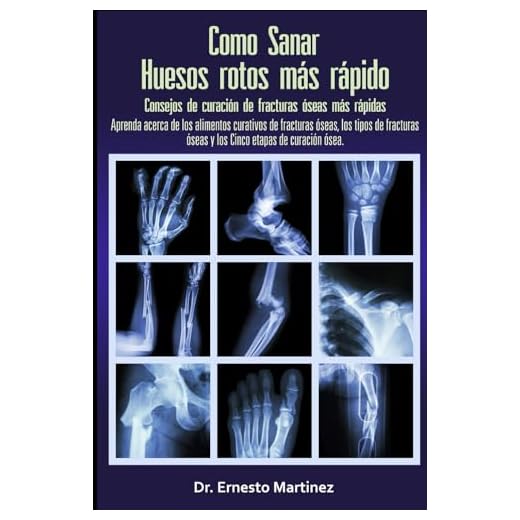 Como curar huesos rotos más rápido. Consejos para curar fracturas de huesos: Aprenda sobre los alimentos para la curación de fracturas, los tipos de ... etapas de curación.: 1 (Health and Wellness)