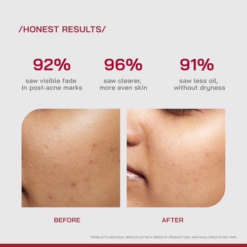 Image of /PHD / 10% Niacinamide Spot Correcting Serum | Niacinamide Serum for Oily Skin, Acne Scars & Enlarged Pores | Face Serum for Acne Prone Skin with 2% NAG | Brightens & Smoothens Skin | Fades Marks, Controls Oil, Removes Blemishes & Pore Care I 30ml