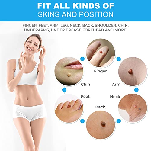 Image of Skin Tag Remover Kit (2-4mm) CONR Micro Painless DIY at Home with Cleansing Swabs Non Toxic Face Care Mole Wart Tool For Small To Medium Skin Tag (not for smaller than 2mm or flat skin tags)