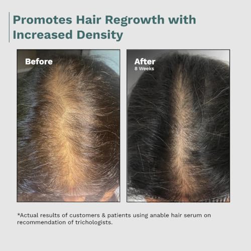 Image of Anable Anti Hair Fall & Hair Regrowth Serum | 3% Redensyl + 3% Procapil + 2% Anagain | Reduces Hair Thinning, Strengthens Hair Roots & Promotes New Growth | For Men & Women | Safe, Non-Greasy & Dermatologist Tested | 50ml