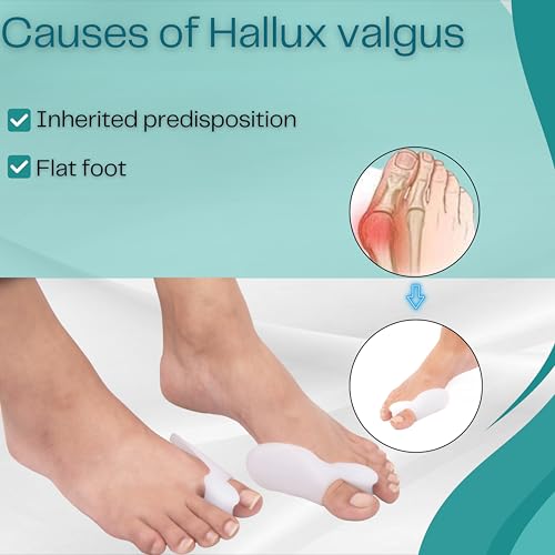 Image of Wonder Care Silicone Toe Separator For Feet Gel Pads Big Toe Corrector Bunion Straightener Yoga Stretcher Hammer Bunion White [Pair of 3-6 Pieces]