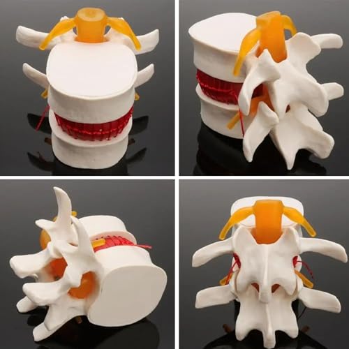 Modèle de hernie discale lombaire pour simplifier les cours d'anatomie complexes
