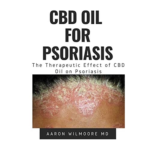 CBD Oil for Psoriasis: All You Need To Know About How CBD OIL WORKS for Treating Dry, Red and Scaly Patches on the Skin