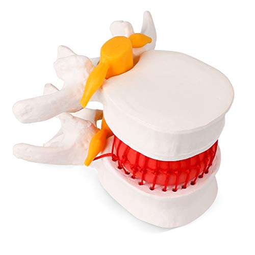 Winyousk Spine Lumbar Degenerative Model, Anatomical Human Lumbar Vertebrae Degenerative Lumbar disc herniation Demonstration Model for Teaching & Learning