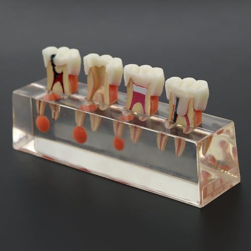 Modèle d'enseignement dentaire Sanfly pour expliquer le traitement endodontique complexe - 5