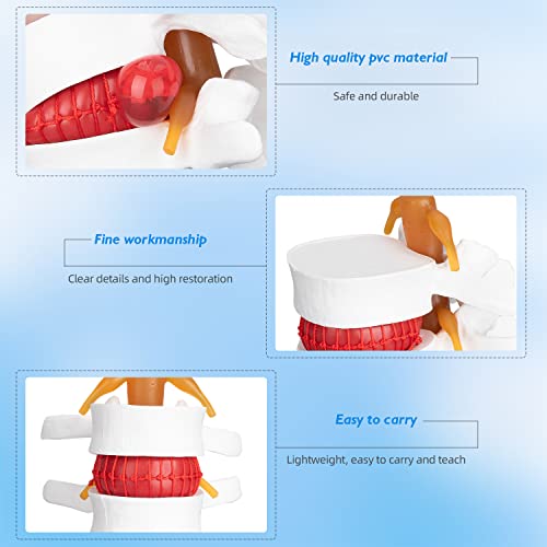 Image of Disc Herniation Model - 1.5X Lumbar Herniated Disc Model Vertebral Spine Anatomical Medical Model