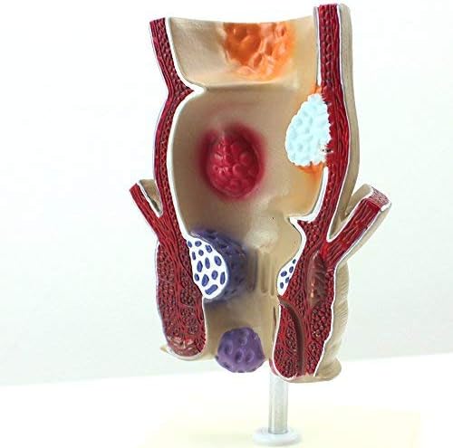 Medical Science Rectum Fissure Lesion Model 1.5X Human Anorectal Pathology Model Hemorrhoid Anal Fistula