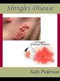 Shingles Disease - The Complete Guide - Everything you need to know about Shingles Disease;  from What Causes Shingles to Treatment for Shingles and everything in between.