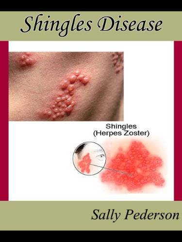 Shingles Disease - The Complete Guide - Everything you need to know about Shingles Disease; from What Causes Shingles to Treatment for Shingles and everything in between.