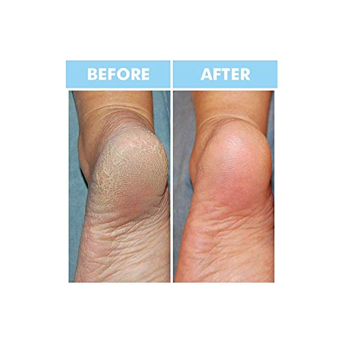 Bodipure Premium Keratin Gloves And Socks For Hydrating Dull Dry Hands And Cracked Heels – Callus Softening – Nail Strengthening – Skin Brightening And Nourishing – 3 Pairs Ea. (3+3 Pack) #TOP5