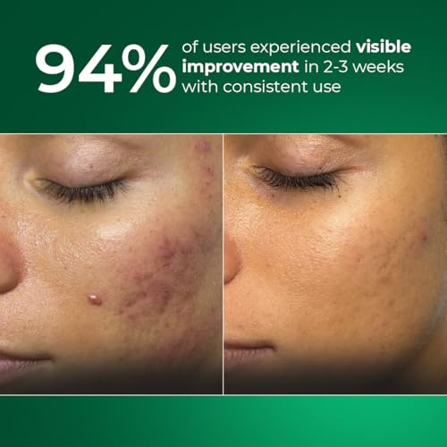 Image of Aqueria Oil Control French Face Wash with 5% Niacinamide | Deep Cleansing, Non-Drying, Non-Stripping Cleanser for Oily, combination & Acne Prone Skin | BHA, Zinc PCA & Multi Actives | Gentle, Non-Irritating, pH Balanced | Fades Acne & Marks, Reduces Blackheads & Excess Oil | Dermatologist Validated, Fragrance Free, Gentle Foaming Formula | Pack of 2 (200ml)