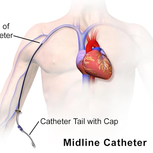 Acessos Vasculares perifericos tipo midlines.