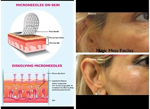 Hyaluronic Acid