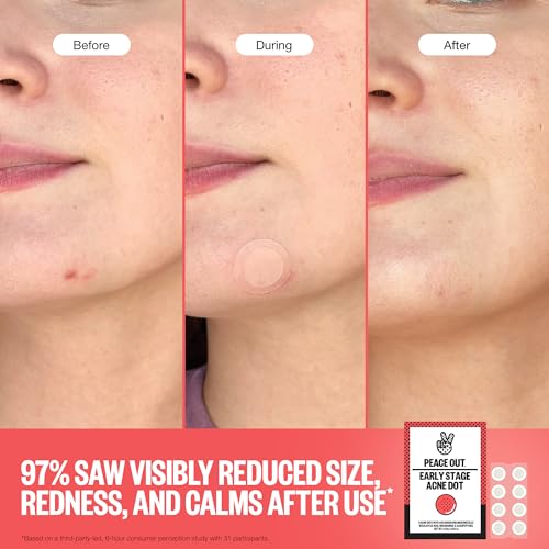 PEACE OUT Early Stage Acne Dots Helps Target Blemishes Below the Surface, Hydrocolloid Pimple Patches Minimize Bumps Before They Appear with Dissolving Microneedles, Salicylic Acid, 8 Count