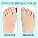 Imagen de Usmlicer 1 Par Calcetines Hallux Valgus
