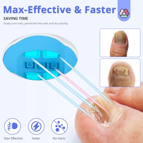 Saviland Upgrade Nagelpflege Gerät: Schnell & Intensiv Nagelpflege,Wiederaufladbares Kalte Therapie Nagelreinigungs und Nagelpflege,470nm Blau & 905nm Infrarotlicht Dual Funktion Nagelpflege&U V Licht
