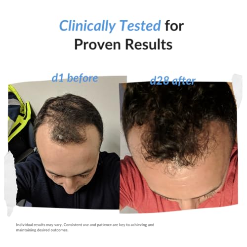 Cheveux clairsemés solution avec REKZE 24 traitement anti-perte et repousse efficace - 6
