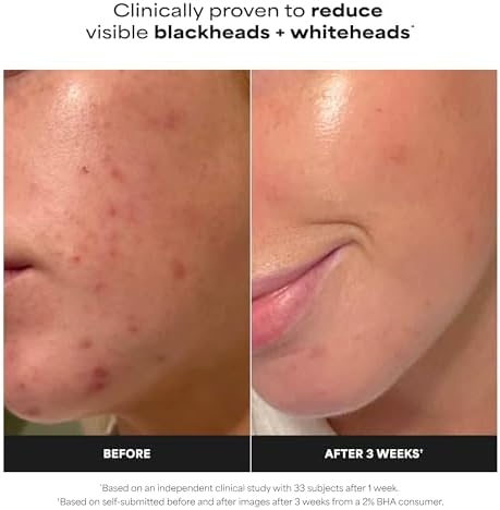 Paulas Choice--SKIN PERFECTING 2% BHA Liquid Salicylic Acid Exfoliant--Facial Exfoliant for Blackheads, Enlarged Pores, Wrinkles & Fine Lines, 4 oz Bottle