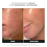 13 Best Treatments to Reduce Pore Size for Women Over 50 2 Paulas Choice--SKIN PERFECTING 2% BHA Liquid Salicylic Acid Exfoliant--Facial Exfoliant for Blackheads, Enlarged Pores, Wrinkles & Fine Lines, 4 oz Bottle