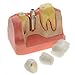 AZDENT Dental Model Implant Analysis Crown Bridge Demonstration Teeth Model Removable Crowns, Education Studying Teaching Display Tooth Model for Adult and Children