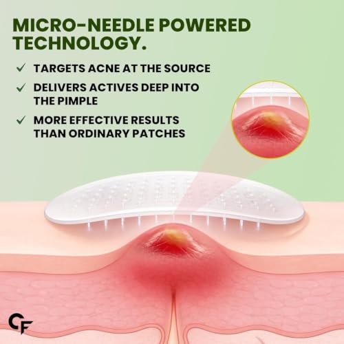 Carbamide Forte Microneedle Pimple Patches | 324 Microneedles | Pimple Patches for Face Salicylic Acid & Hyaluronic Acid | Invisible Waterproof Acne Patches for All Skin Types - 9 Patches - Image 4