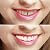 Imako Cosmetic Upper Teeth 1 Pack (Small, Natural)