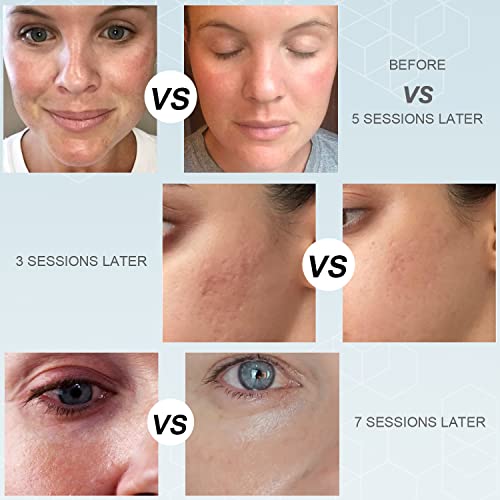 Microneedling Pen Electric Derma Roller - Tilmann Professional Wireless Adjustable Microneedle Wand Derma Pen Skin Care Tool For Face Body Home Use 16 36 Nano Cartridges #TOP6