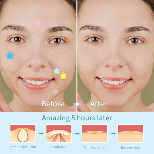REDANHA 200 Counts Star Pimple Patches for Face, Hydrocolloid Acne Pimple Patches with Tea Tree Oil for Party Gift Covering Zits Blemishes
