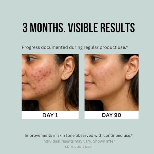 Image of 3% TRX + 2% Salicylic Acid Serum for Acne prone skin, Pigmentation, Open Pores, Oily Skin & Blackheads | Face Serum for Acne and Dark Spots for Men & Women 30ml