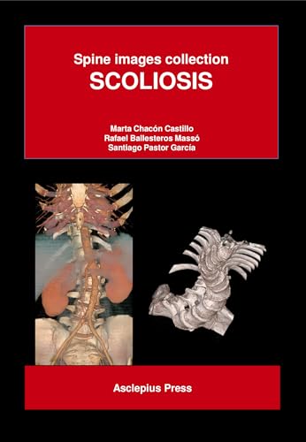 SCOLIOSIS (Spine Images Collection) (English Edition)