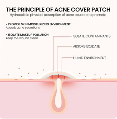Okian Patch de espinhas, tratamento hidrocolóide para acne, para cobrir espinhas, 200 unidades